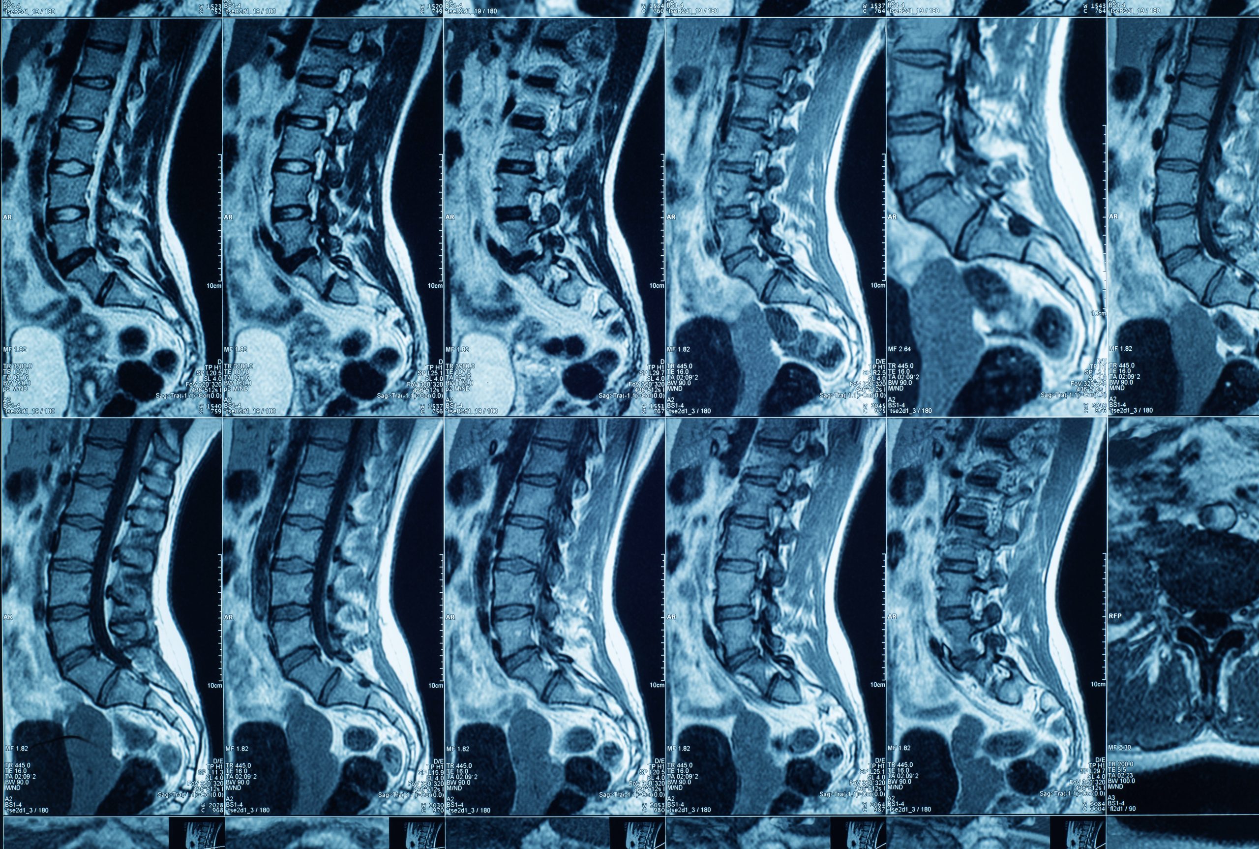 Magnetic resonance imaging of human spine